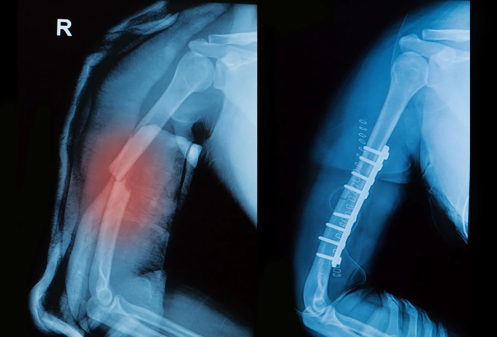 Where Do Hairline Fractures Most Commonly Occur?