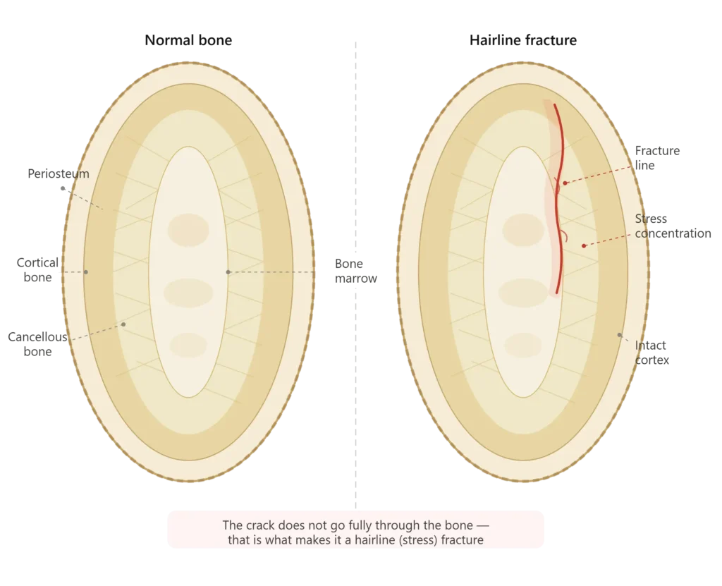 Complications of Untreated or Undertreated Hairline Fractures