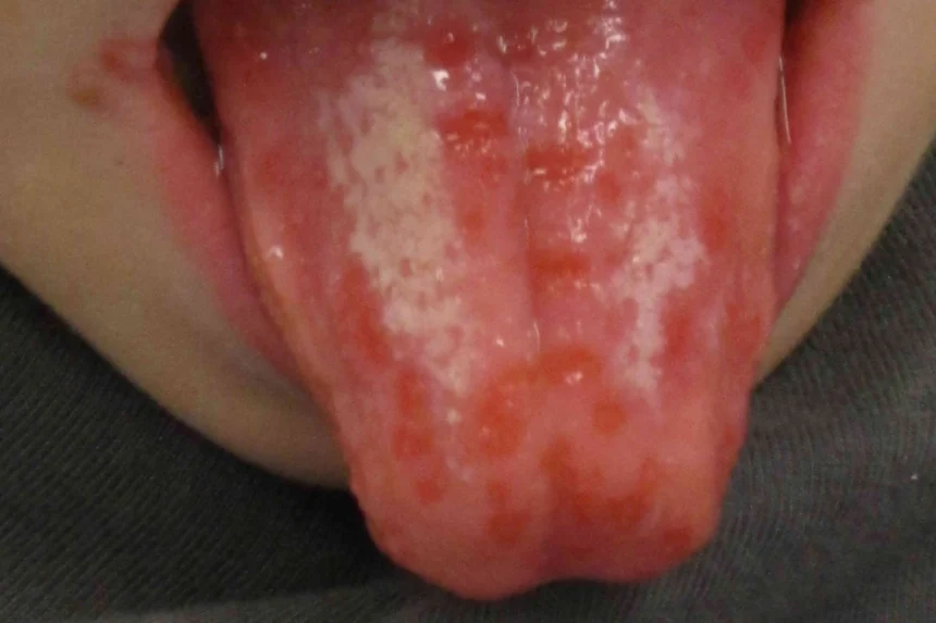Bump Inside the Tongue