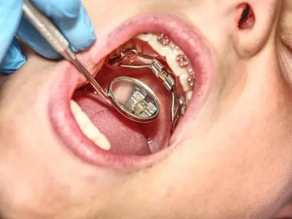 Bump on the Roof of My Mouth