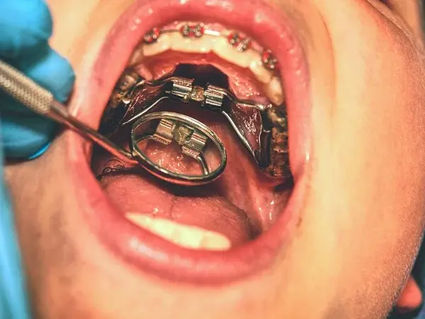 Bump on the Roof of My Mouth