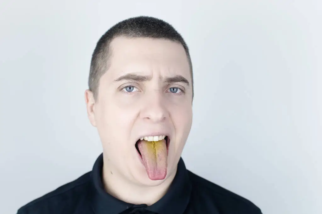 Why Does the Roof of My Mouth Look Yellow?