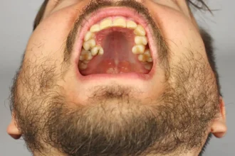 Yellow Roof of Mouth