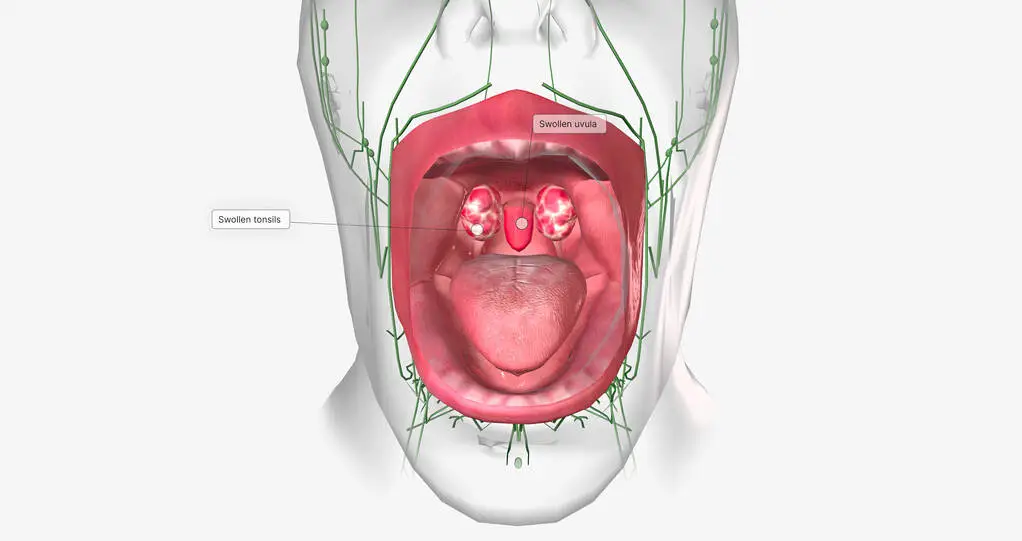 Strep Throat Pictures What Does It Look Like?